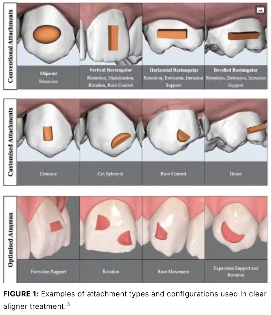 Vì sao attachment quyết định thành công trong điều trị bằng khay trong suốt?